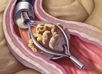 Рак простаты и большой камень мочевого пузыря